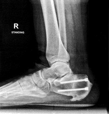 Lateral view of the right foot and ankle at 6 weeks post-surgery (weightbearing) demonstrates screw fixation and healed osteotomy of the calcaneus.